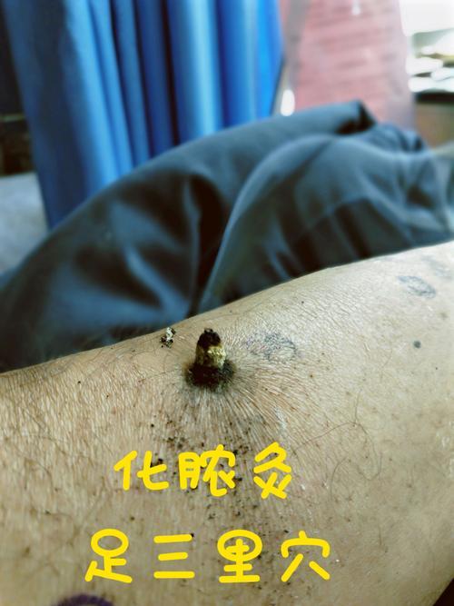 中医绝技化脓灸——改变体质的手段 - 知乎