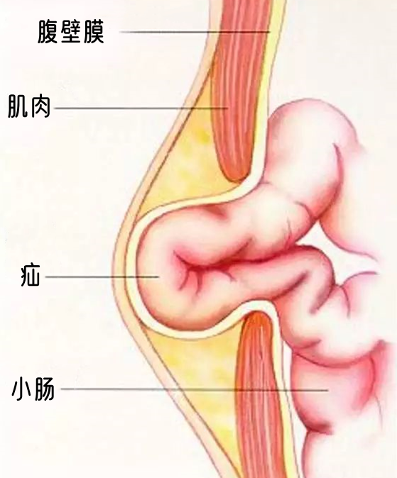 睾丸疝气是什么病图片