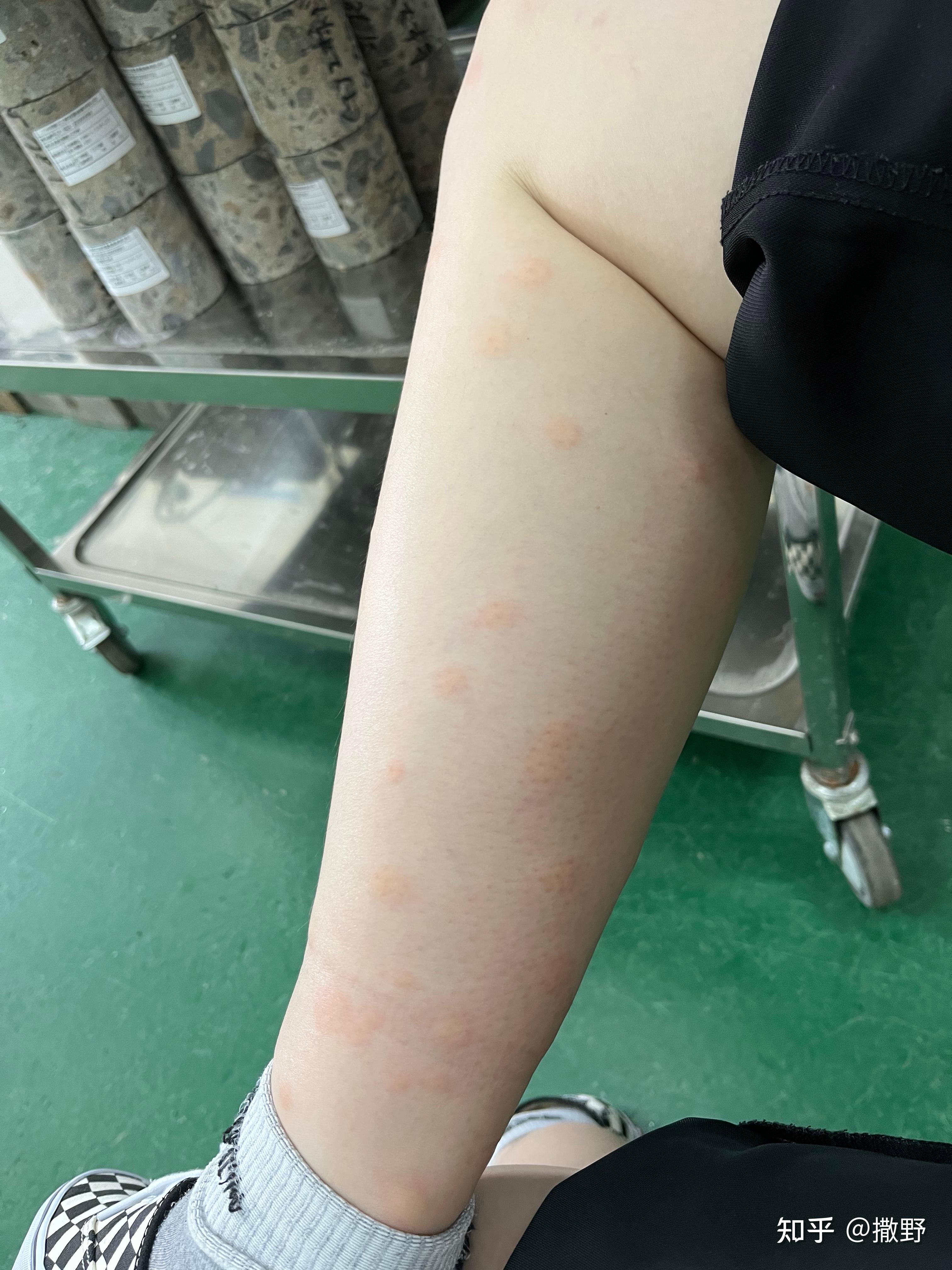 蠓一种很难发现的小黑蚊被折磨了好多年了昨天出门又被咬到又痛又痒