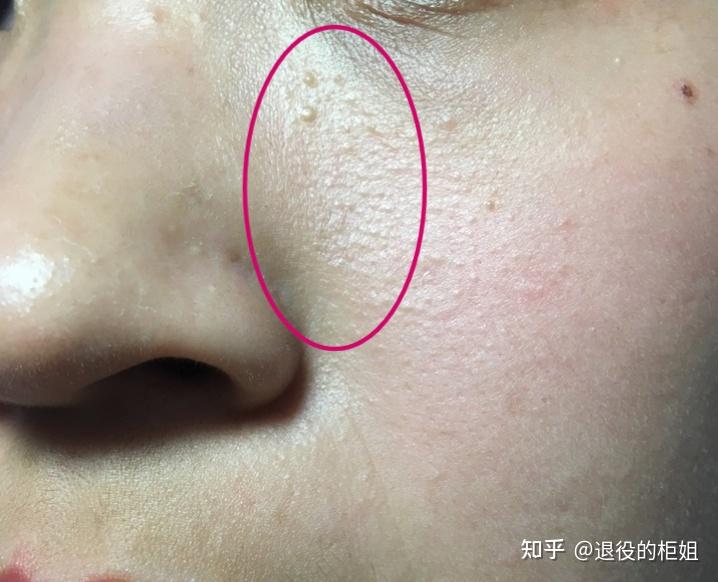 鼻翼两侧突出的小白点,以及鼻子上不断长出来的脂肪粒怎么处理?