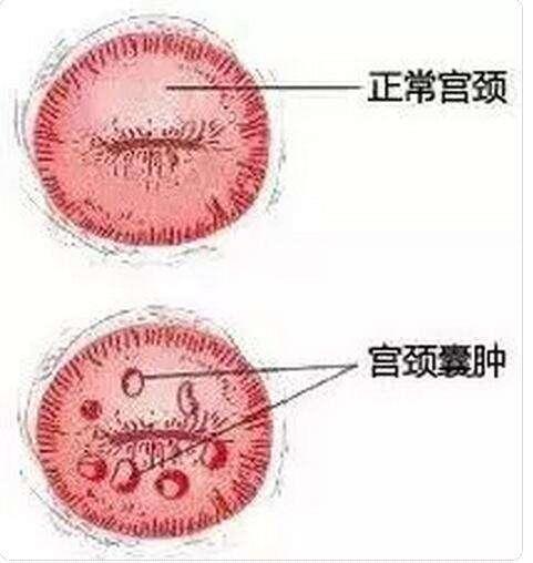 宫颈囊肿是什么?