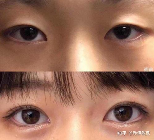 试试中度重度内眦赘皮 肿眼泡的人,他们敢做吗?