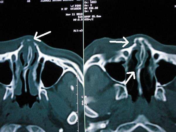 鼻骨解剖及ct诊断 供法医鉴定参考 知乎