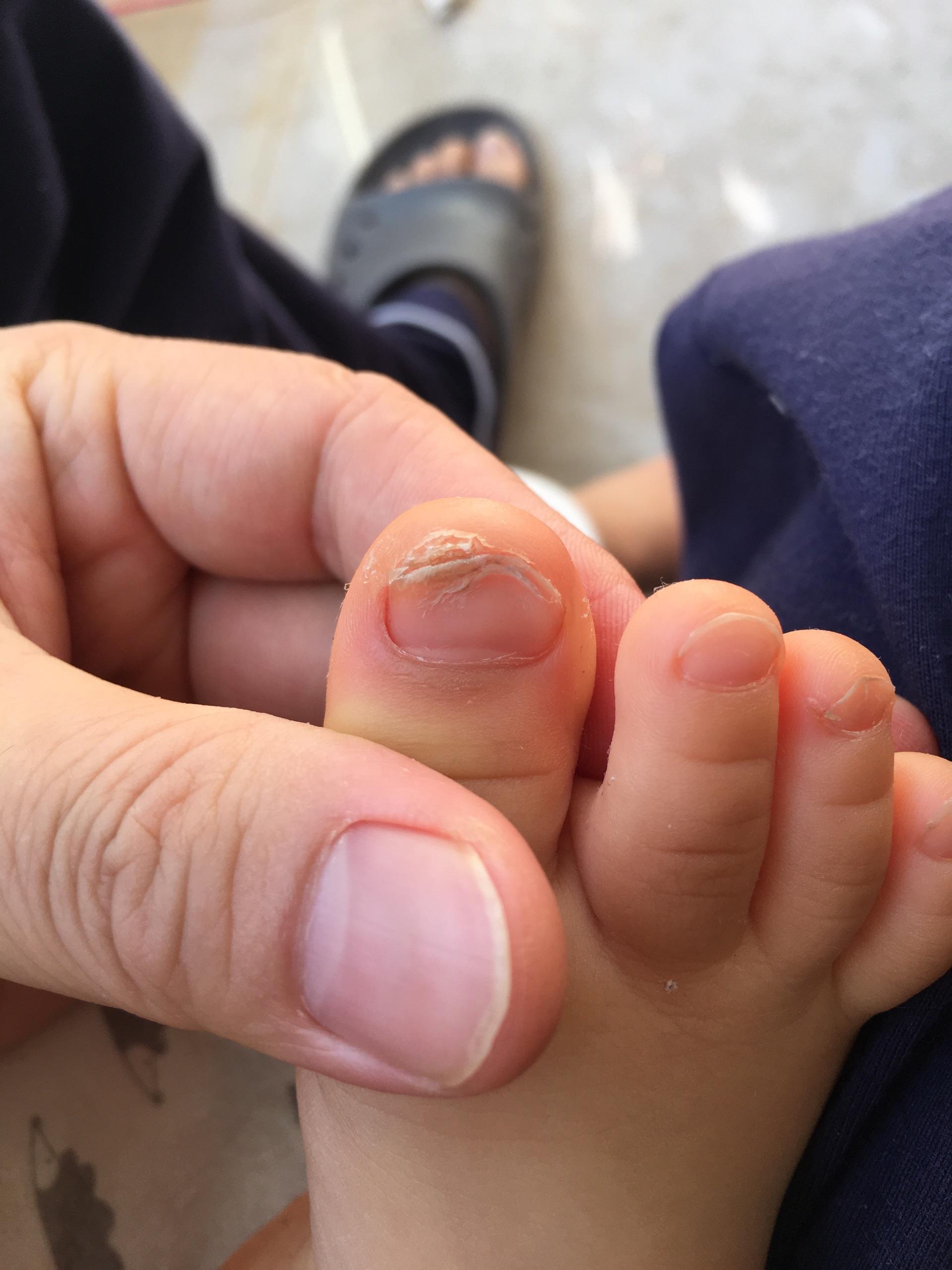 发现小儿指甲有点异常,有经历过的宝爸宝妈或医生,请给些建议,谢谢你