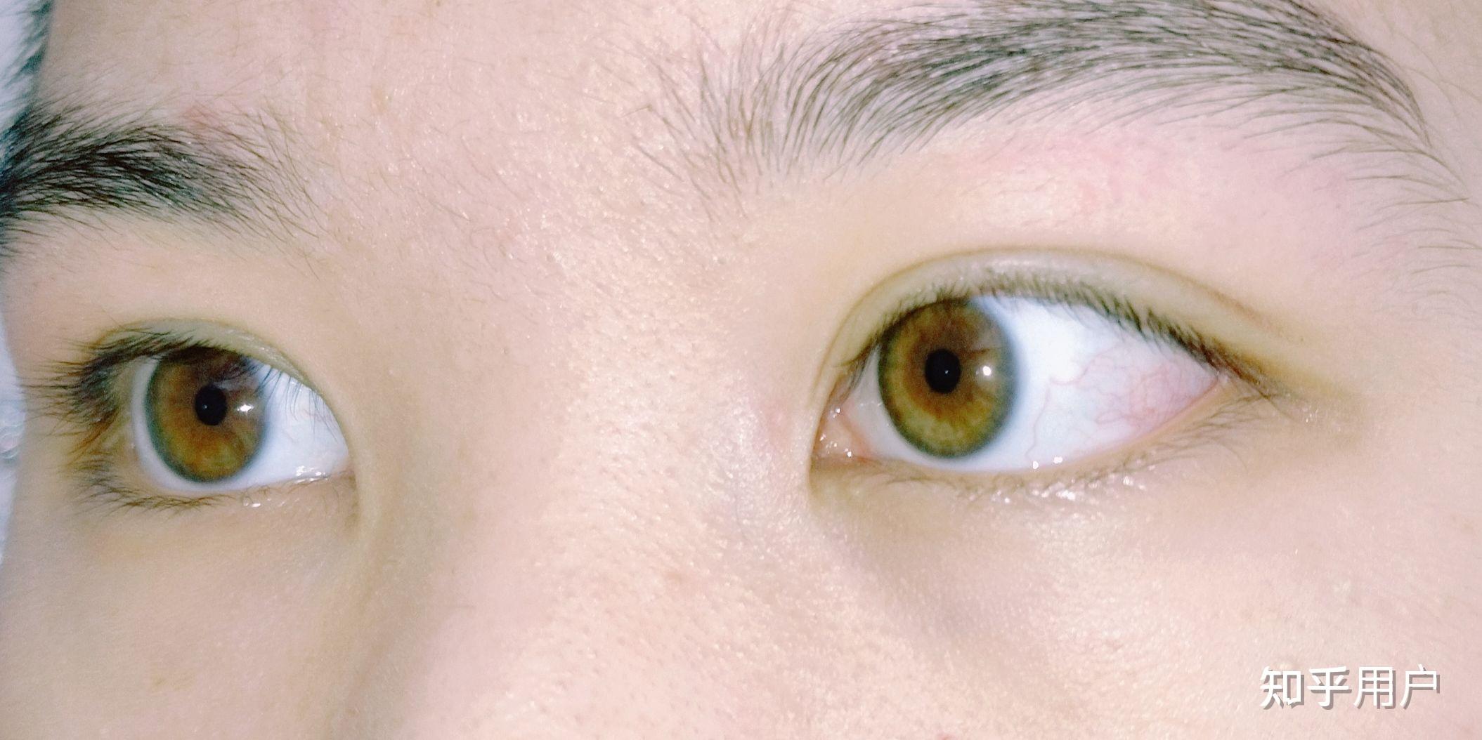 眼球虹膜颜色越来越浅请问这是正常的吗还是病变的前兆