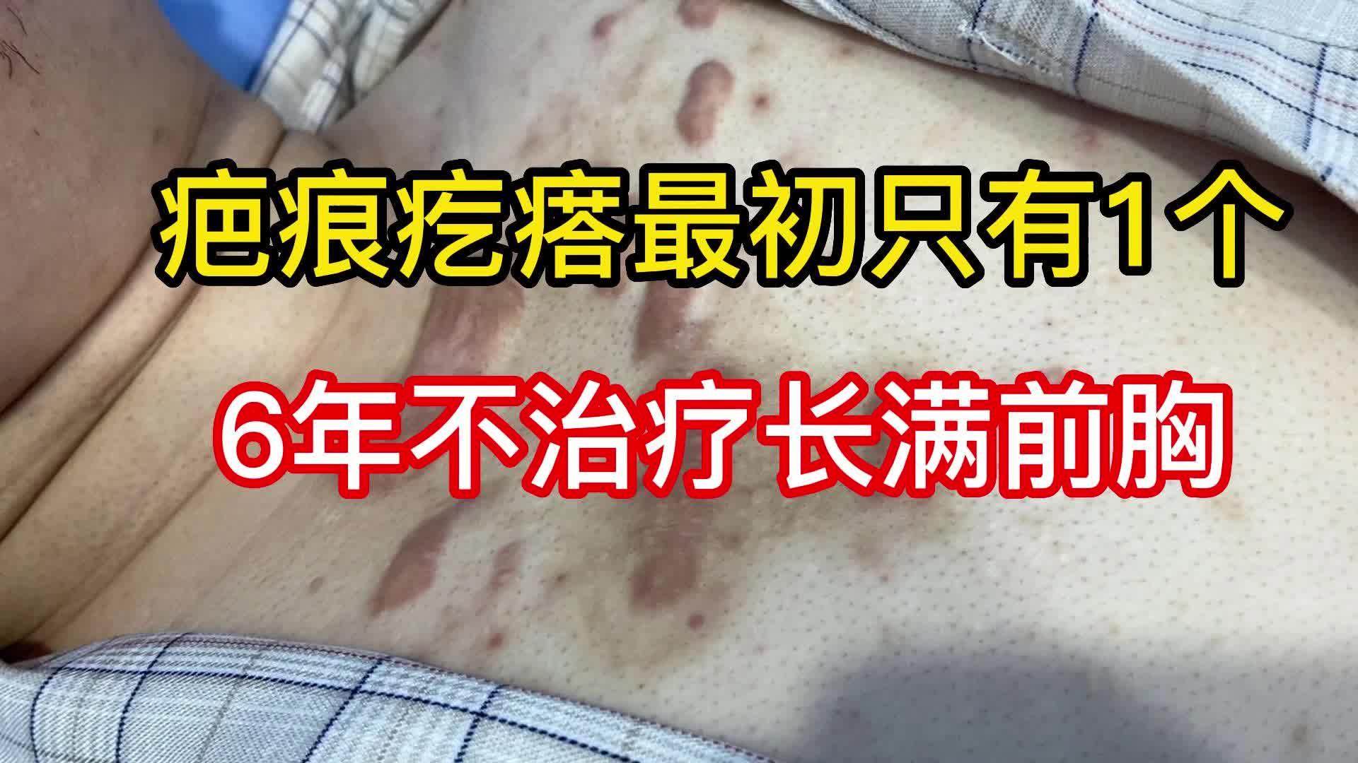 胸口1个疙瘩不治疗6年后长满了一边治疗一边后悔