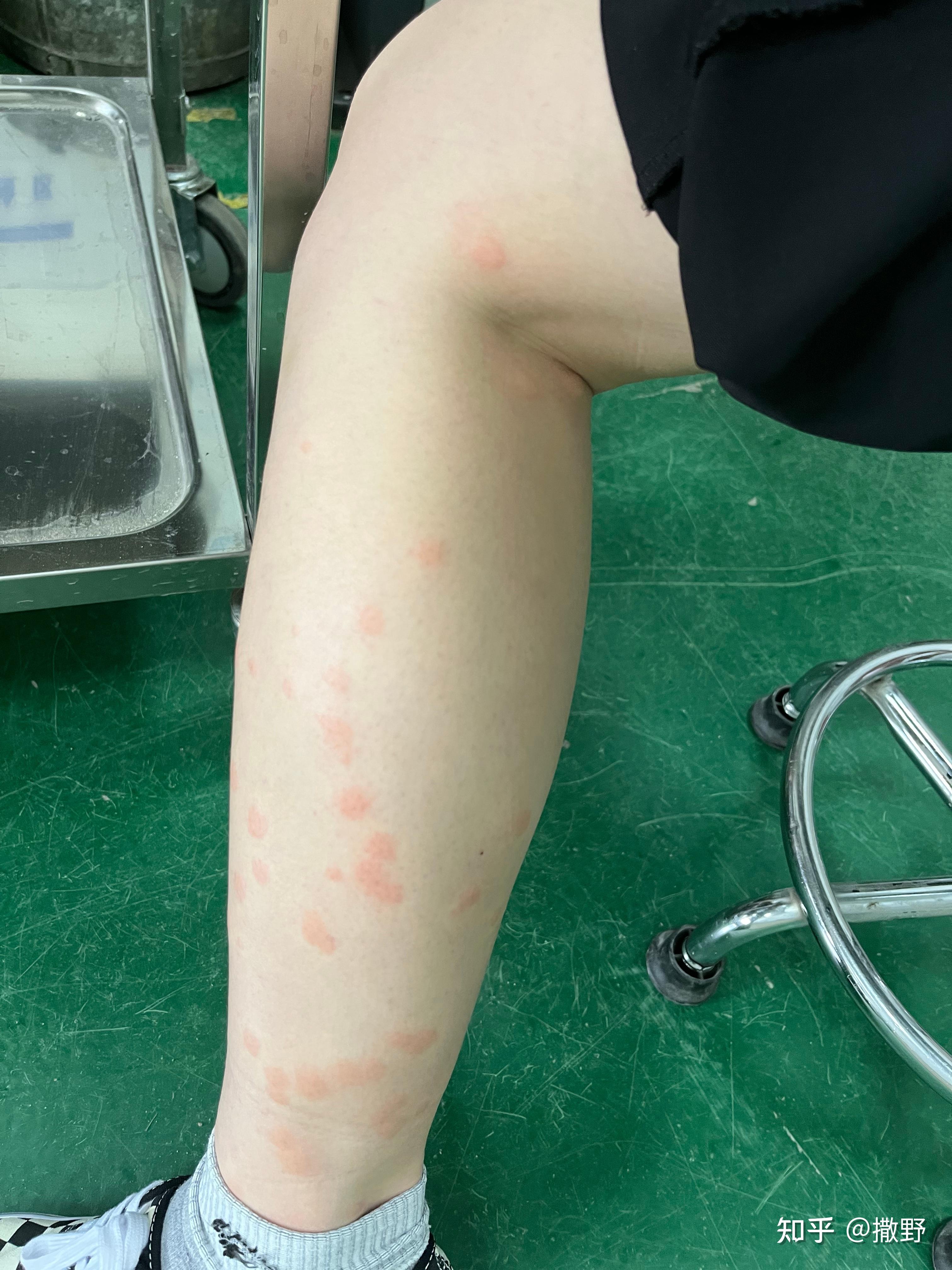 蠓一种很难发现的小黑蚊被折磨了好多年了昨天出门又被咬到又痛又痒