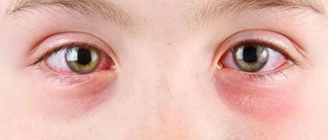 儿童眼红、眼肿、眼痒,要当心过敏性结膜炎 - 知乎