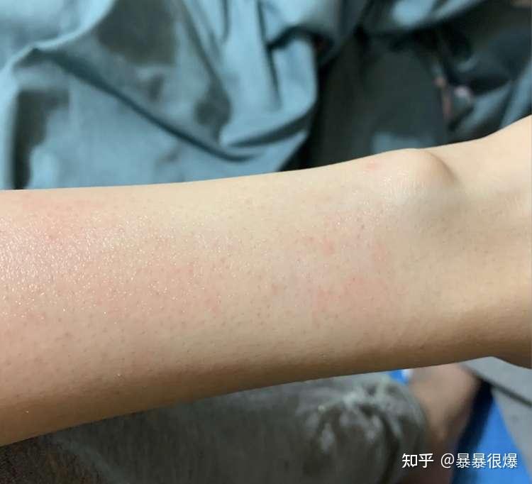 女生长期脱毛是什么体验?