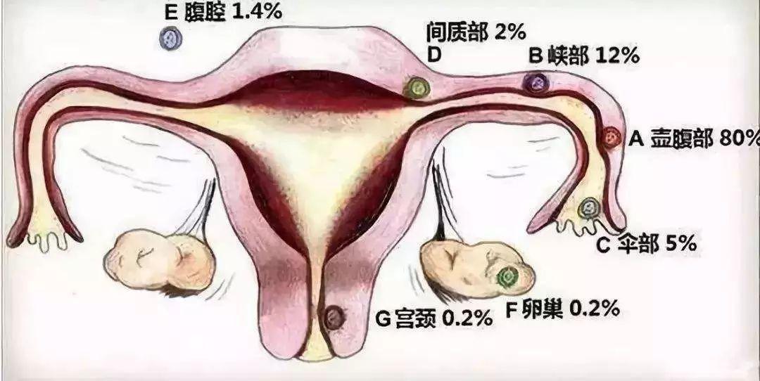 异位妊娠位置图片