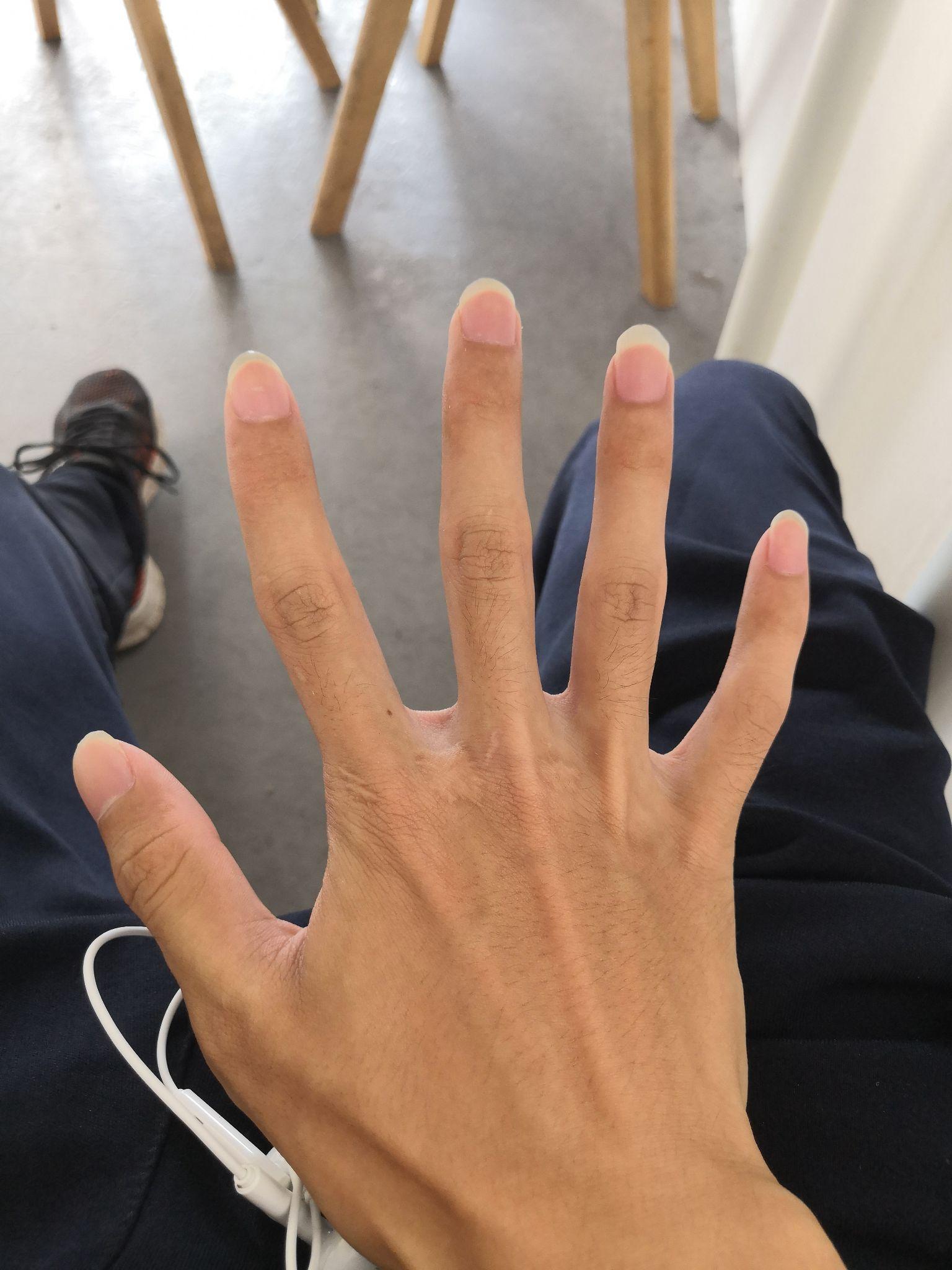 手指长歪了到底是什么情况