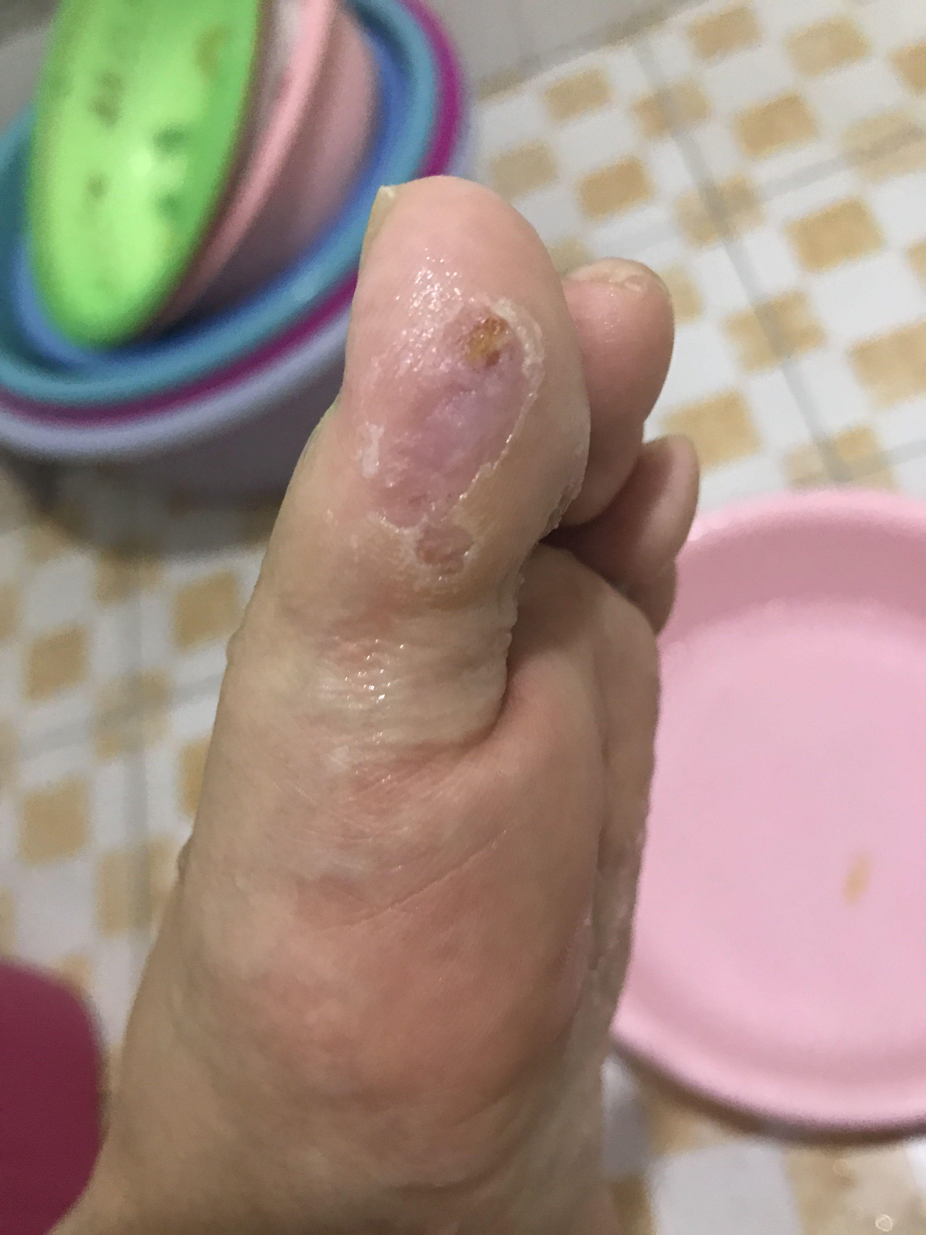 激光后跖疣再起