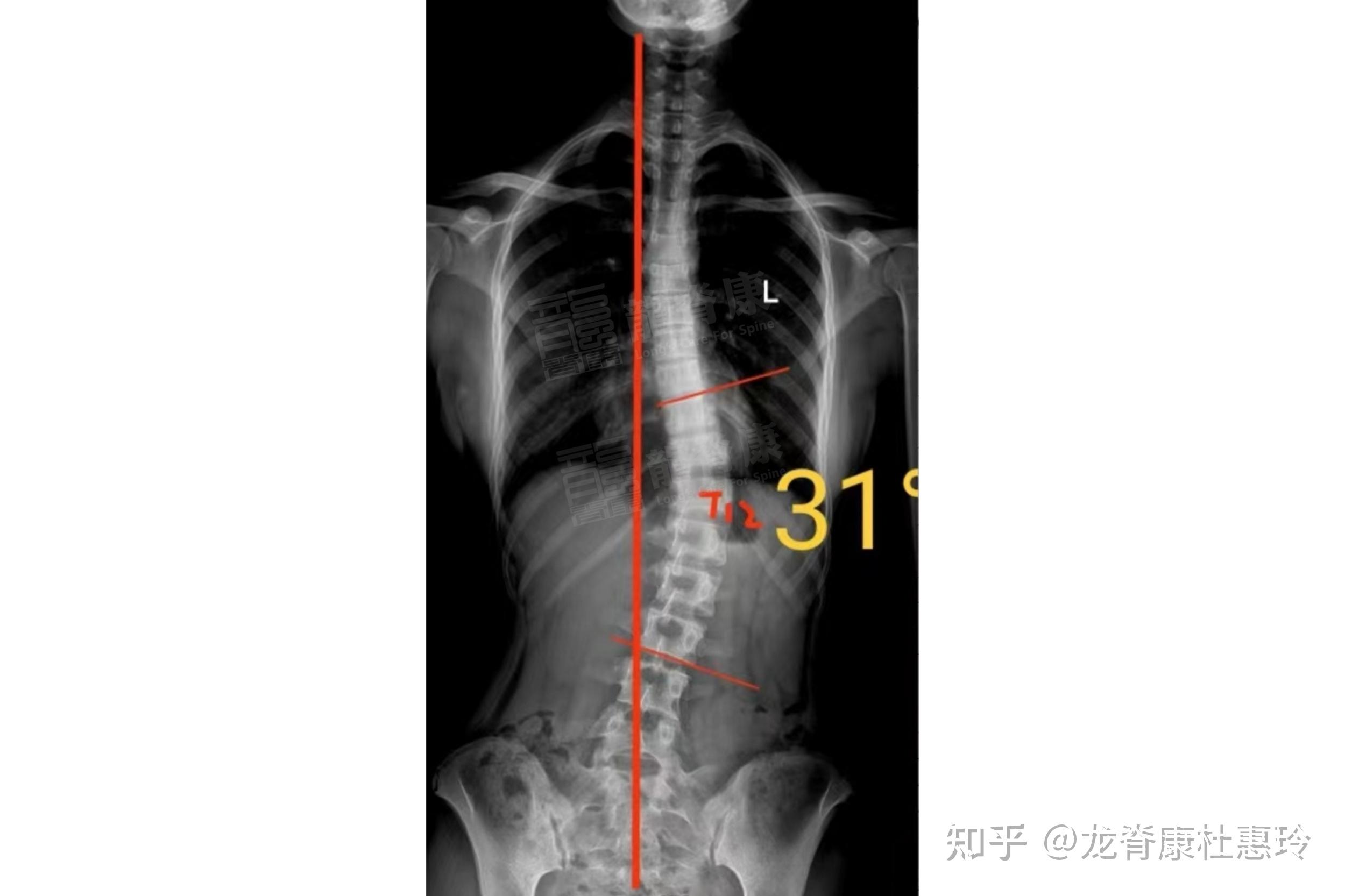 成人脊柱侧弯3天强化训练,剃刀背从19°减至12°,中线基本回正! - 知乎