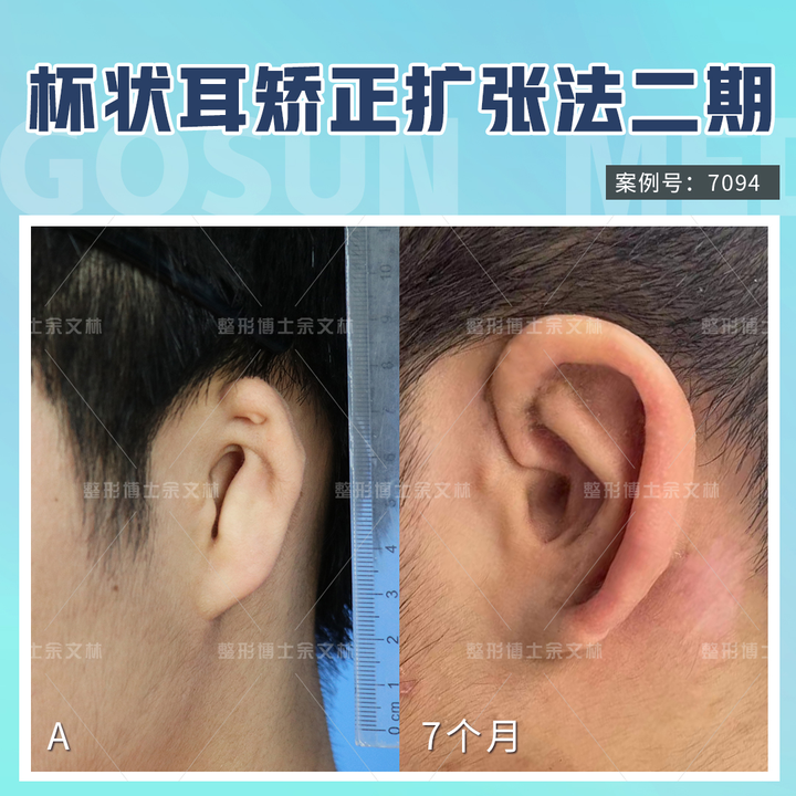 小耳畸形修复手术中,残耳怎么处理的? - 知乎