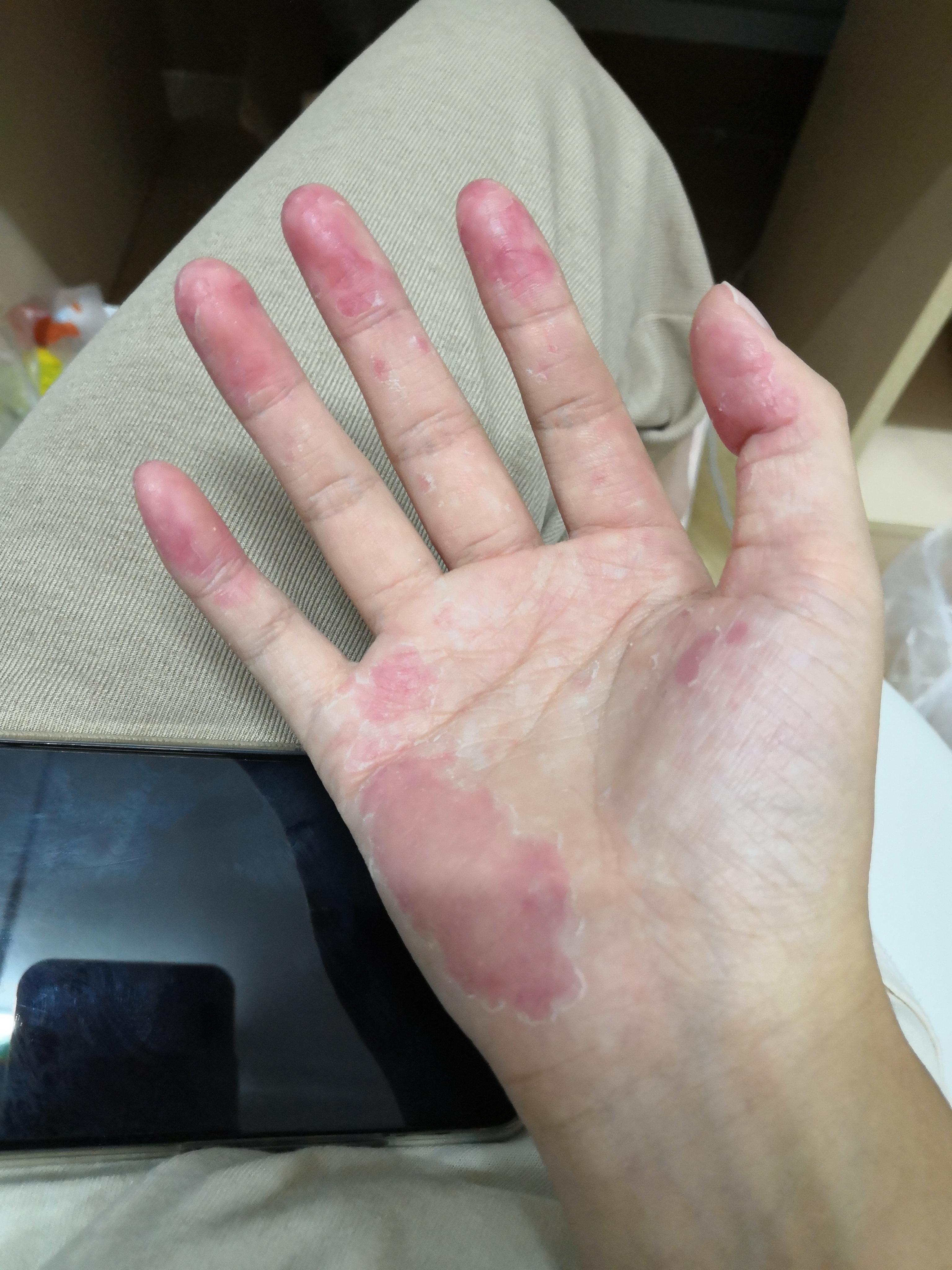 为什么手指头经常脱皮变硬? - 知乎