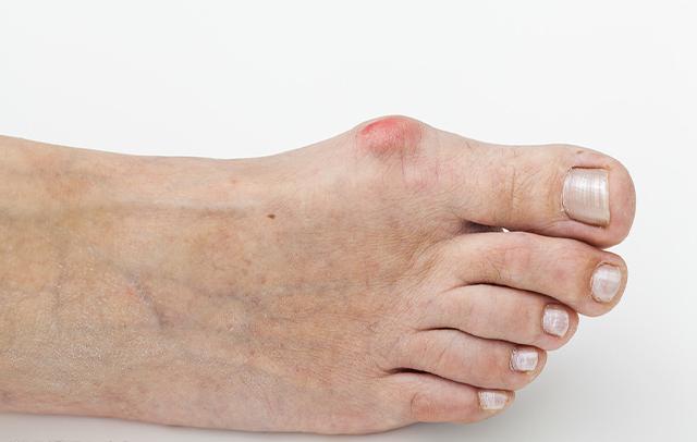 上海虹桥医院科普大脚骨的纠正与因素