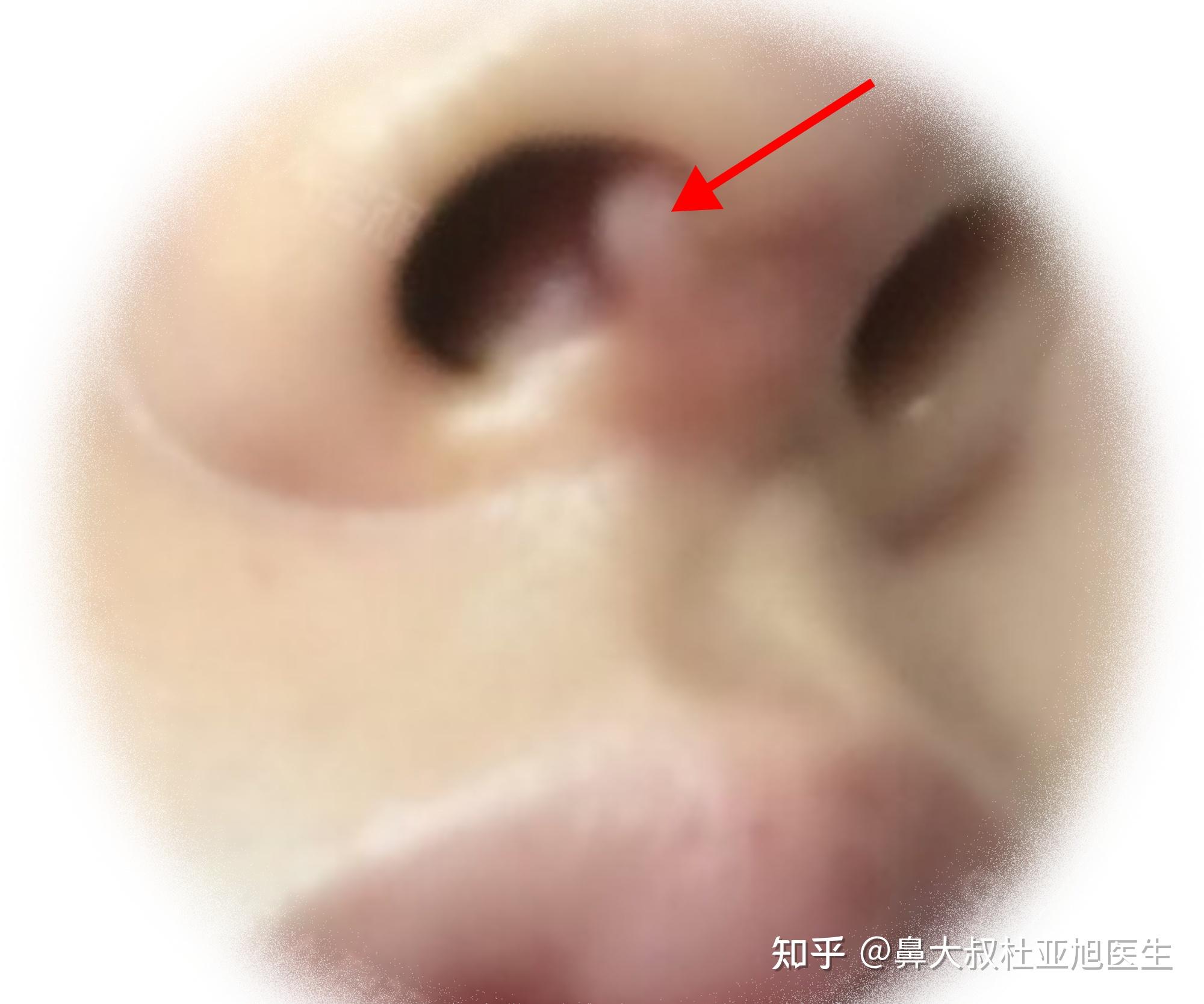 为什么有人隆鼻后鼻孔会出现白色突起物而且越来越厉害?