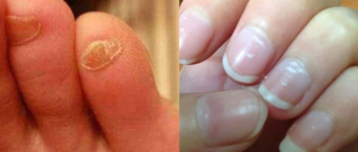 指甲两半山西人,指甲白点有蛔虫,你猜啥是真的?