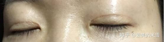 割双眼皮两三年了肉条还这么明显如何修复