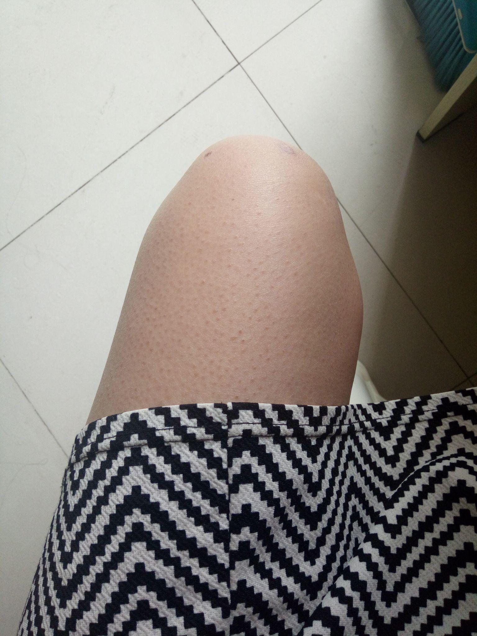 皮肤鸡皮肤怎么解决(皮肤是鸡皮肤如何改善)