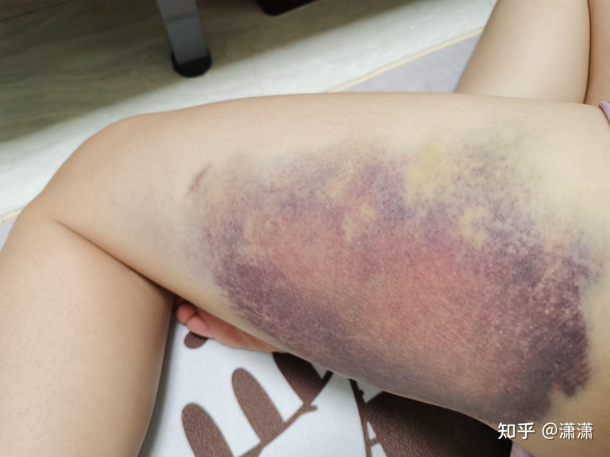 淤青变成淤紫,是严重了还是好点了.