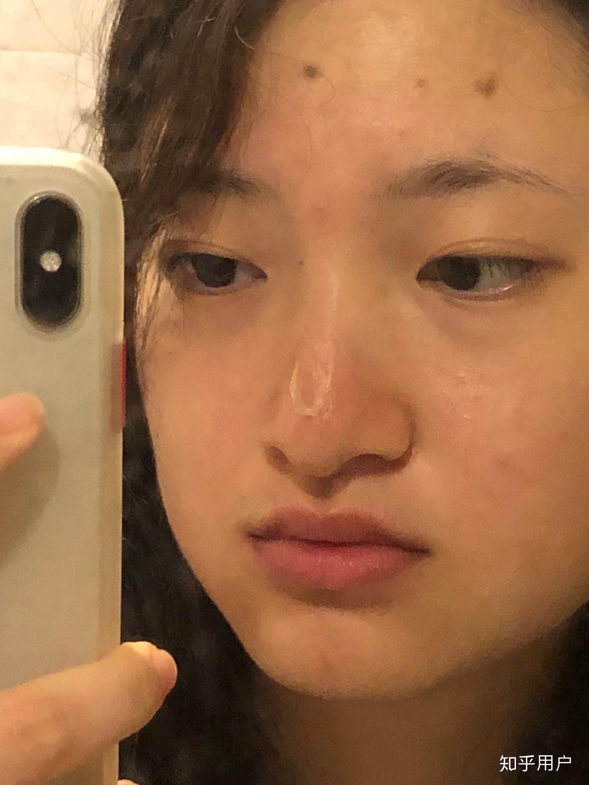 脸晒伤啥样? - 知乎