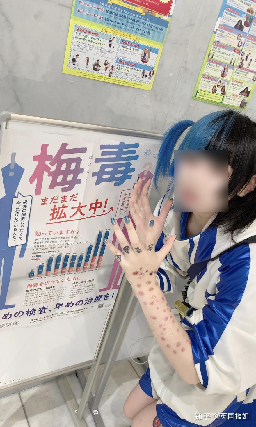 奇葩!日本年轻人热衷晒梅毒疤?感染人数连年暴增引担忧! - 知乎