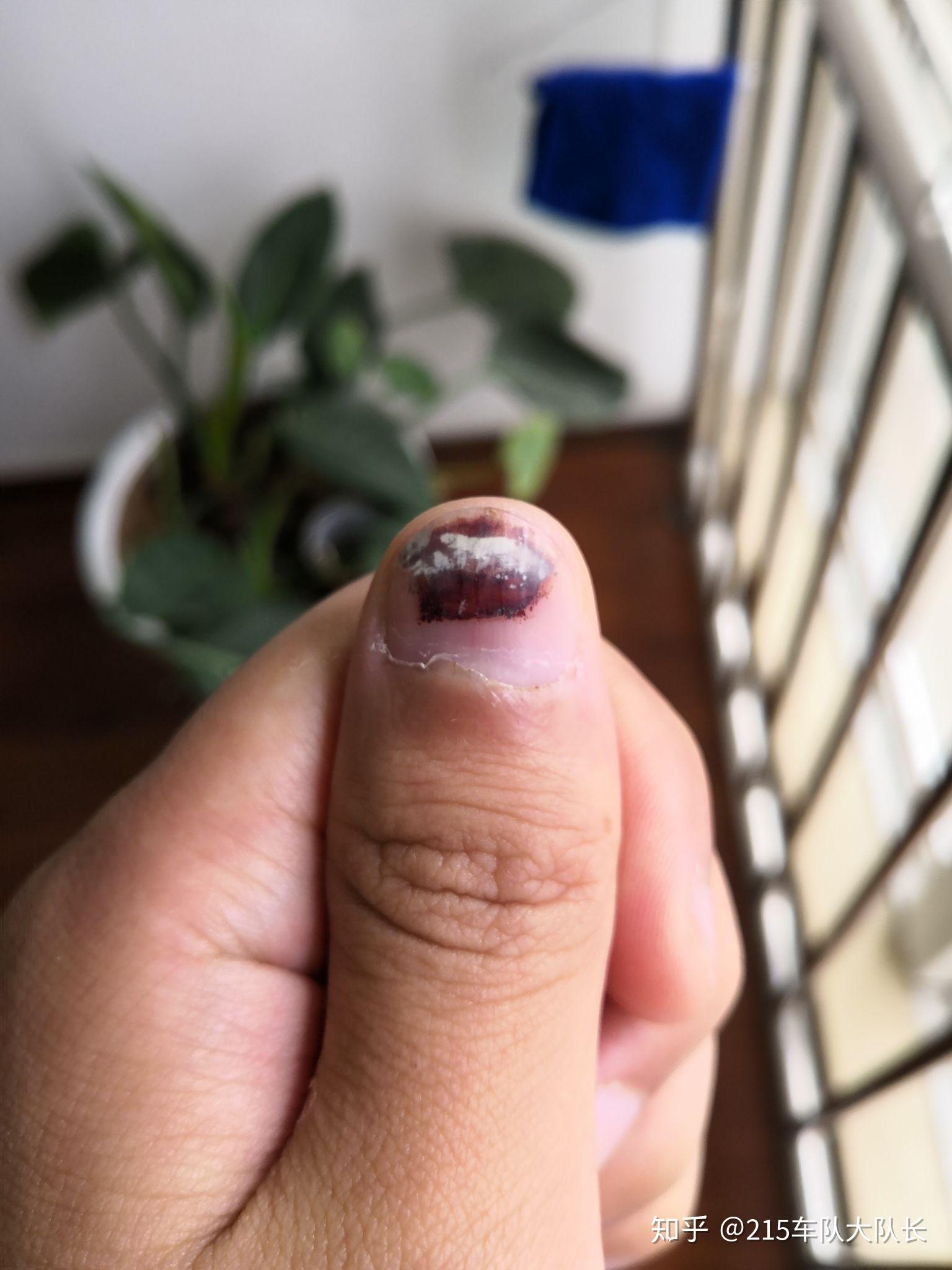 手指被夹,指甲根部发黑,一直疼痛,怎么办? - 知乎