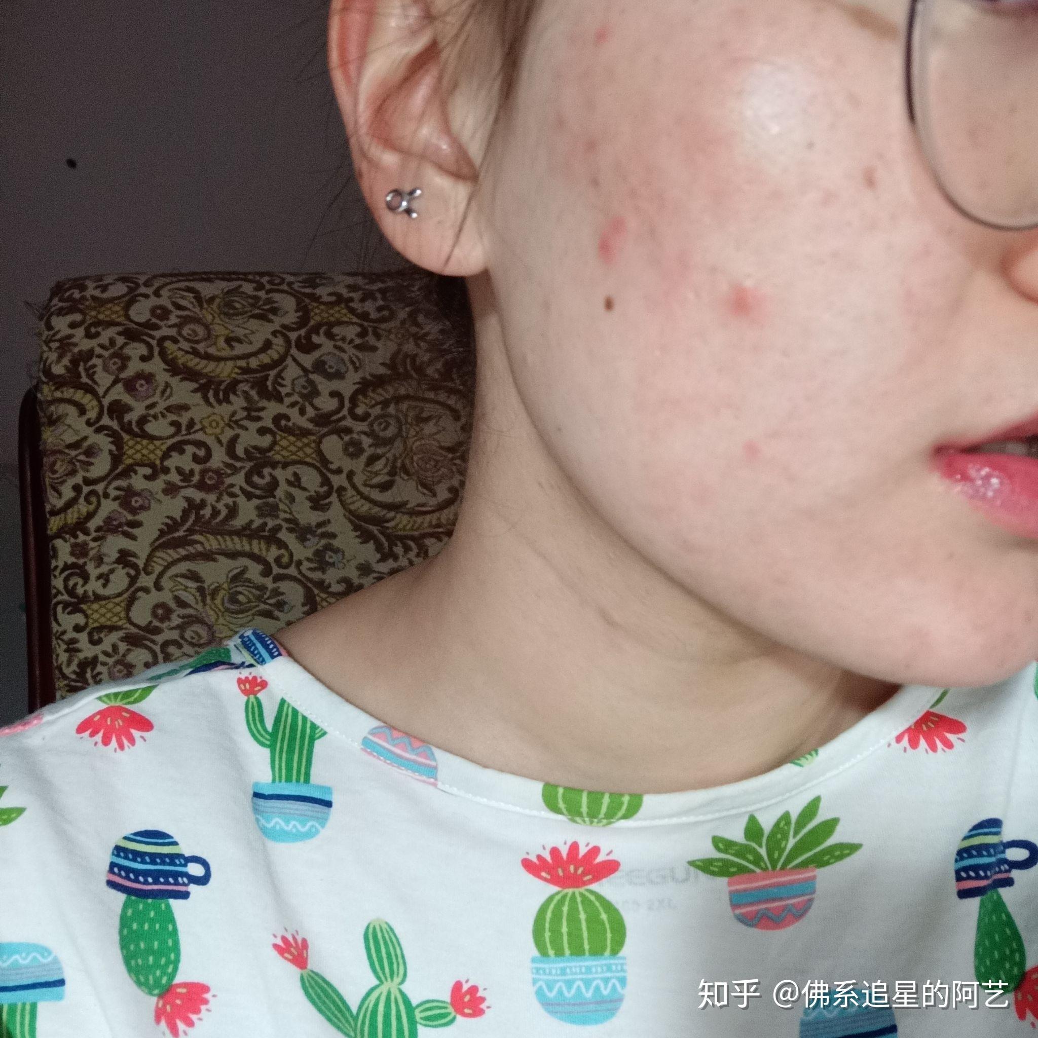 吃异维a酸软胶囊对治疗重度痤疮有效吗对身体有什么影响