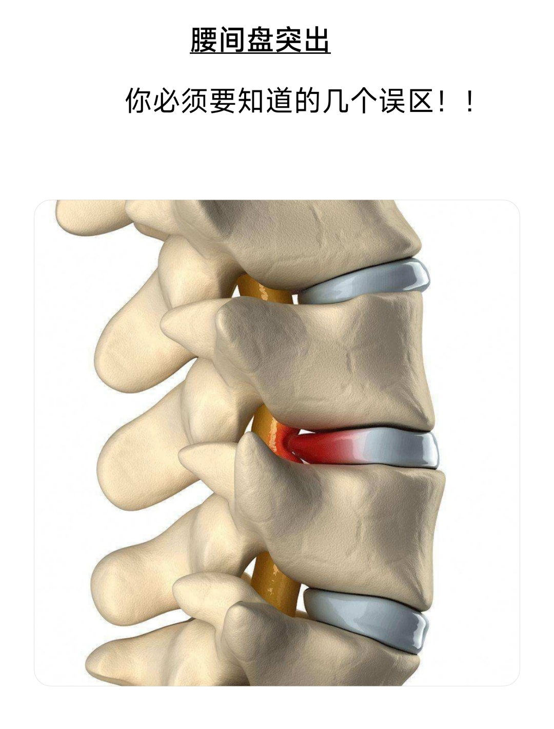 腰椎间盘位置图图片