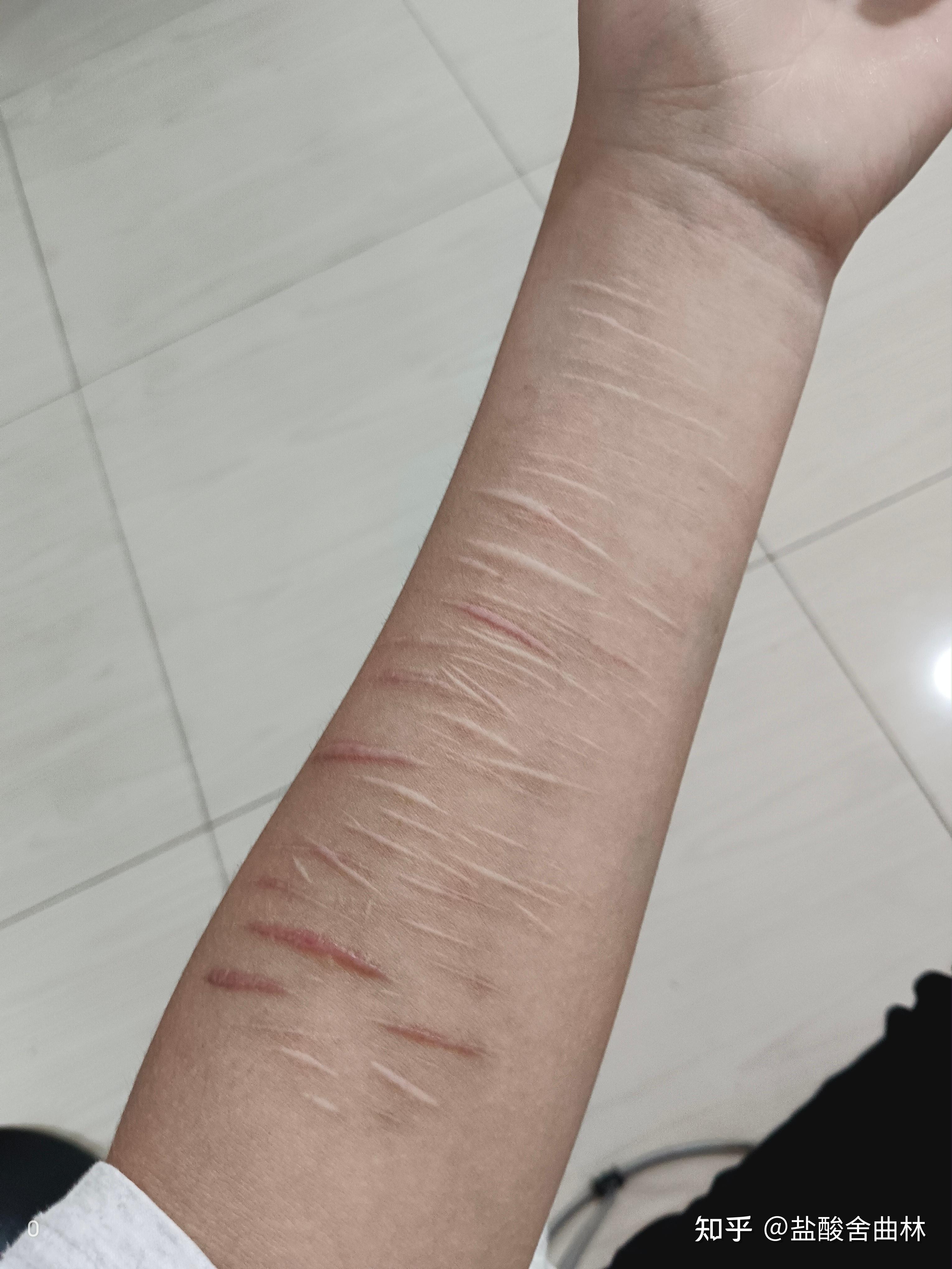 抑郁症自残留下的疤真的很丢人吗