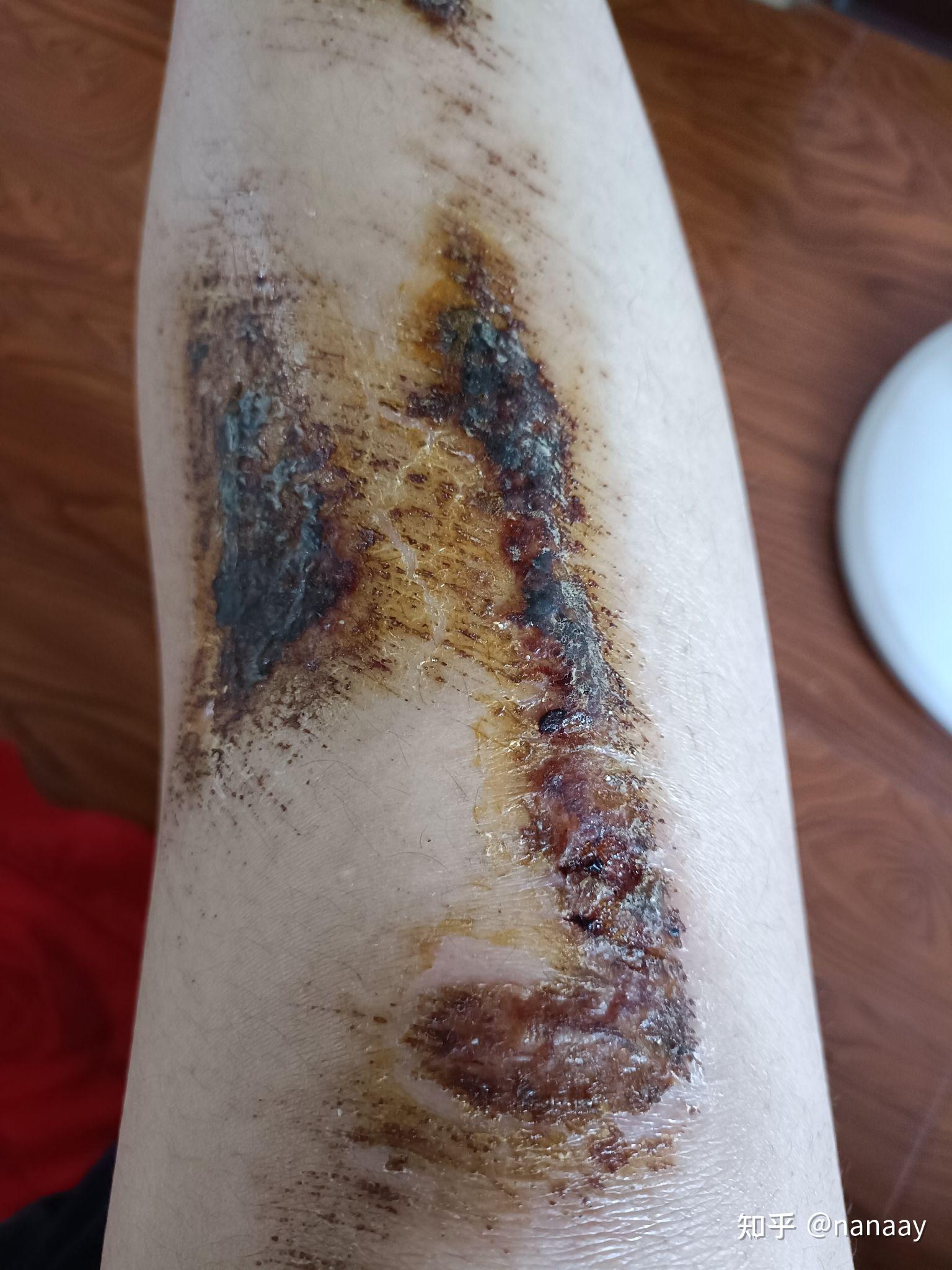 膝盖摔伤,抹了碘伏结痂后如何防止留疤?