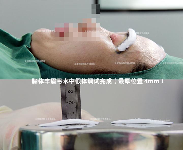 假体丰眉弓会改变眉眼间距么?垫高眉弓眼尾会有提升的感觉么? - 知乎