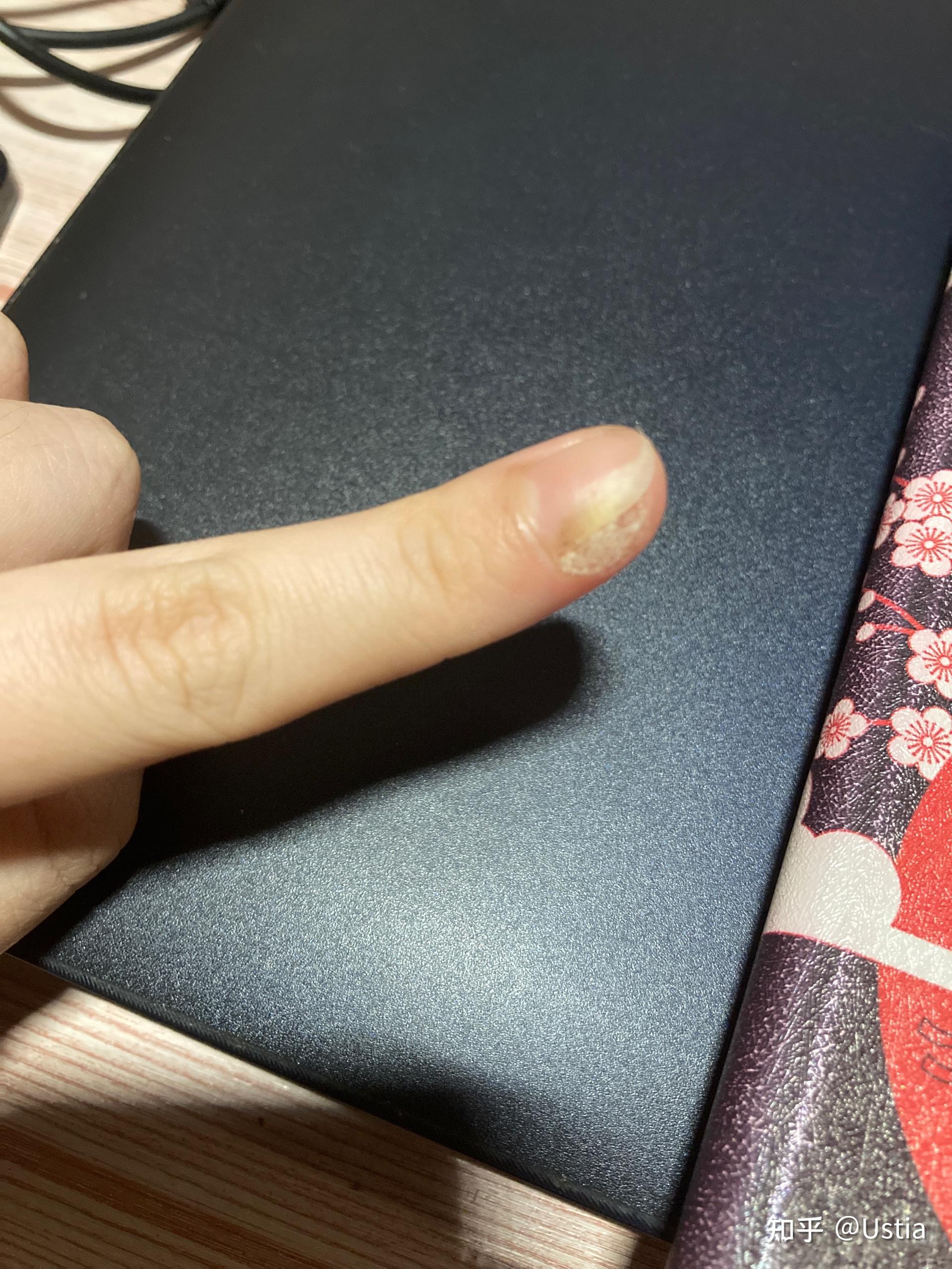 各位大神鄙人手残手指甲旁边长了死皮用指甲刀剪的时候把一些肉也剪了