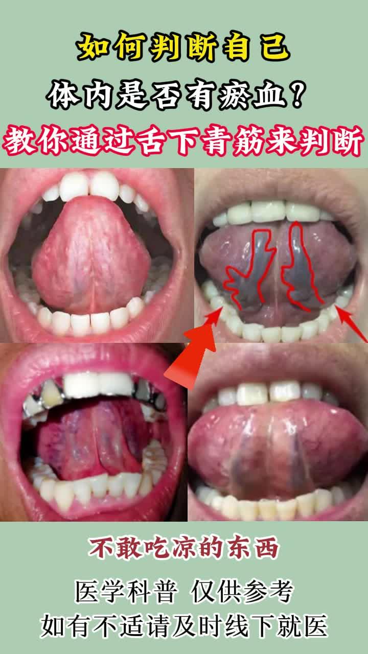 如何判断自己体内是否有淤血?教你通过舌下青筋来判断