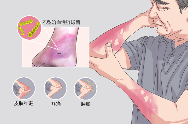 “丹毒”到底是什么毒?这三类人群十分危险,想要预防牢记这五点 - 知乎