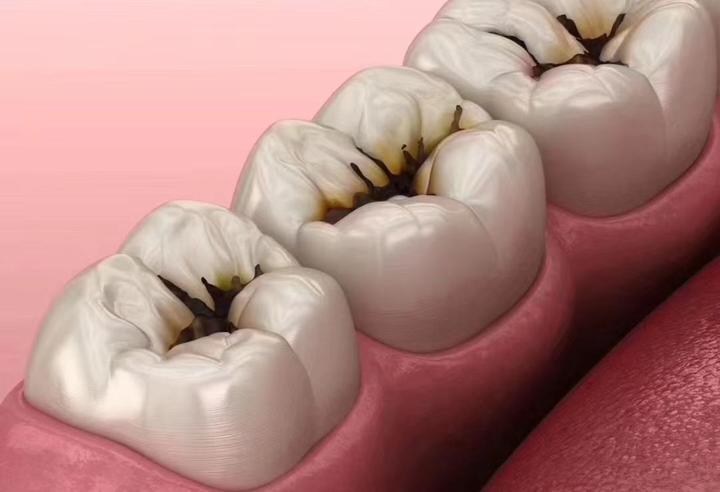 牙齿惊现黑线?带你揭秘出现黑线的原因/阶段/治疗/预防?(上)