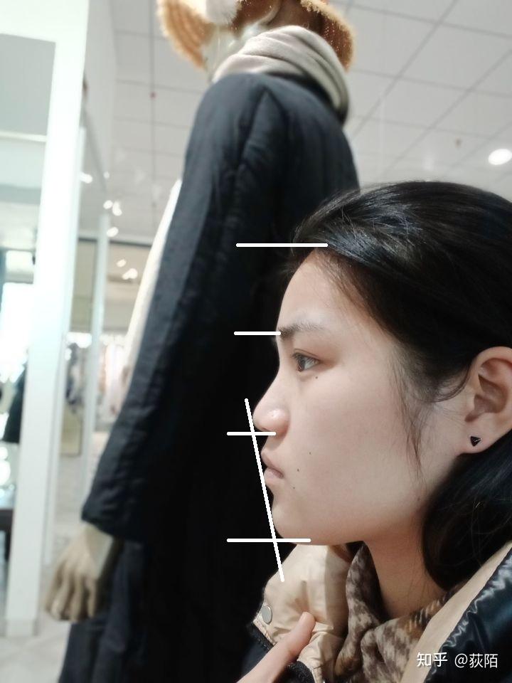 侧脸丑需要怎么改善