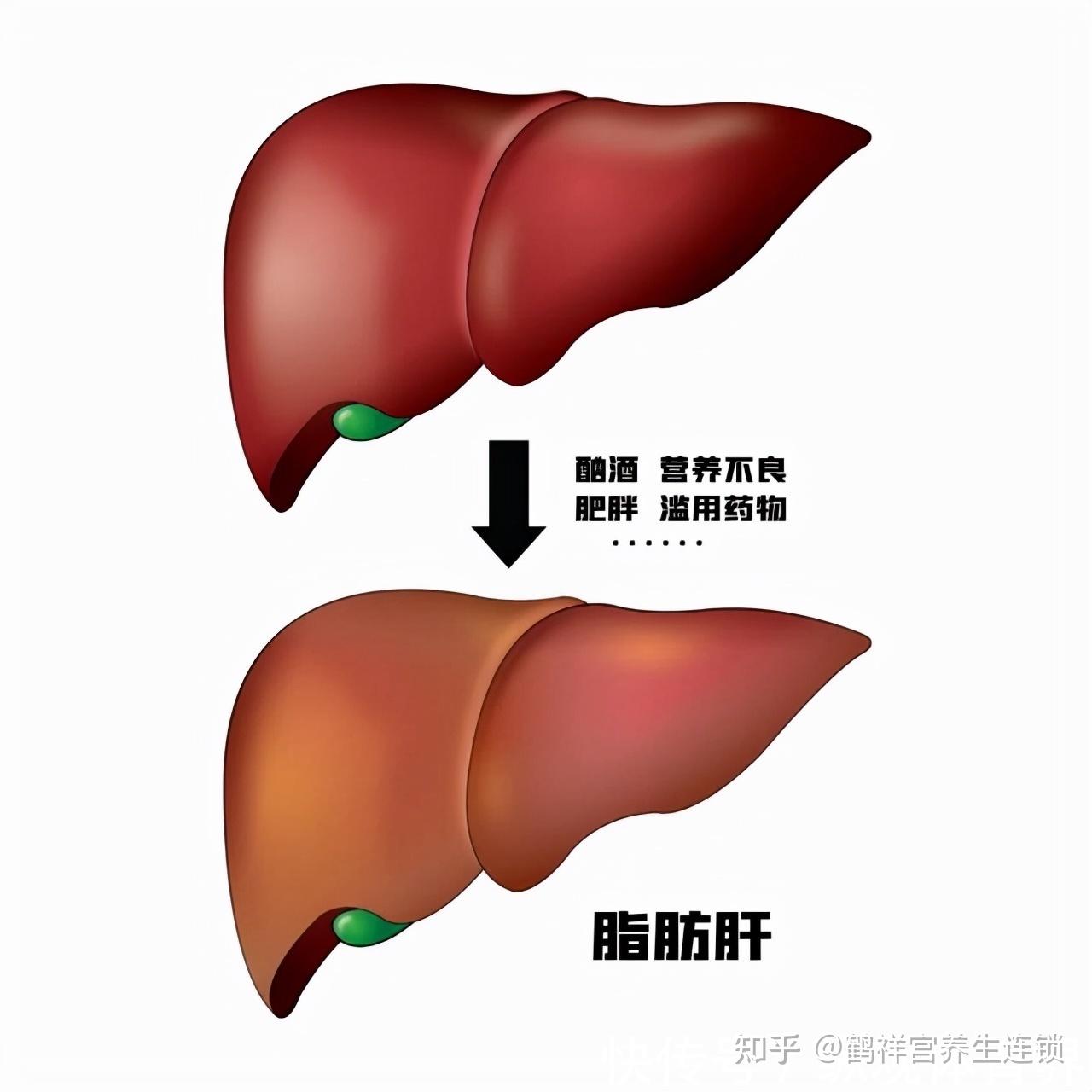 为什么长期喝酒会患上脂肪肝