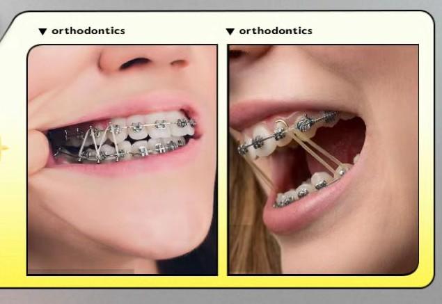 牙齿矫正橡皮筋挂法图片