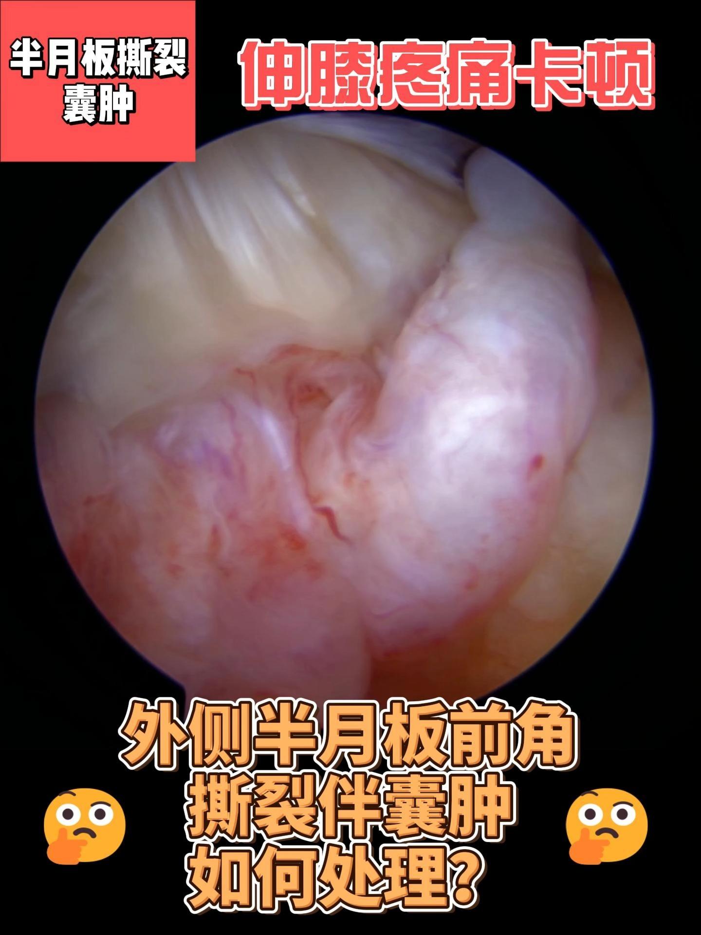 外侧半月板前角撕裂伴囊肿,如何处理?
