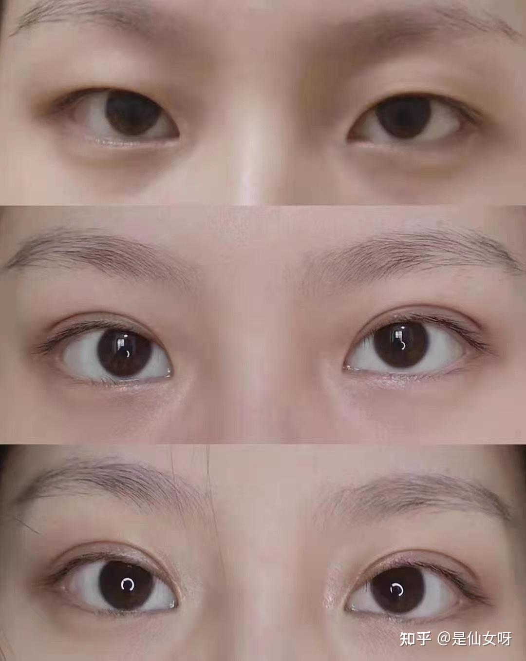 西京医院哪位医生做双眼皮比较自然