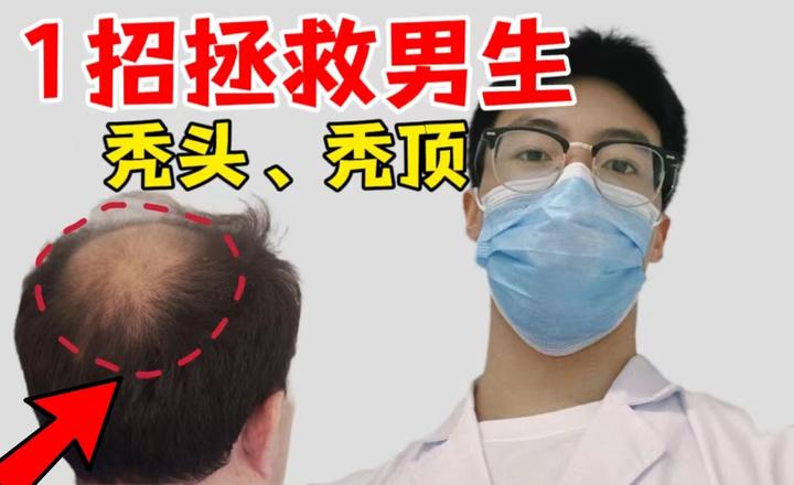 男生掉发严重，发量稀疏见头皮怎么办？秃头、秃顶怎么才能把头发养回来？【专业药剂师】教你4步防脱，轻松养出浓密秀发！ - 知乎