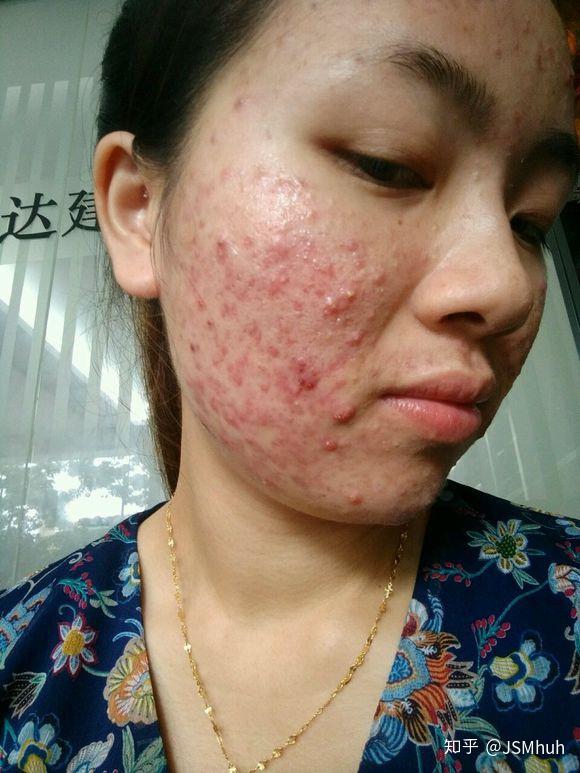 脸上很大很硬的痘痘挤不出来东西,一个月自己消? - 知乎