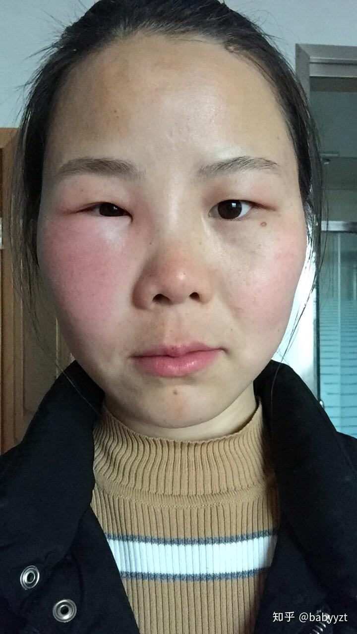 为什么被蜜蜂蛰了会起包被蜇后该怎么办