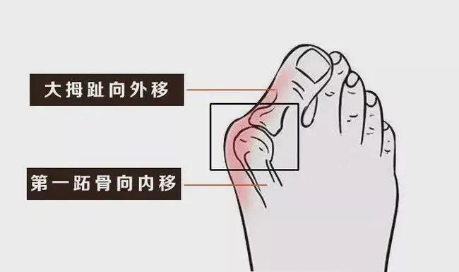 【拇外翻需要做哪些检查？】 - 知乎