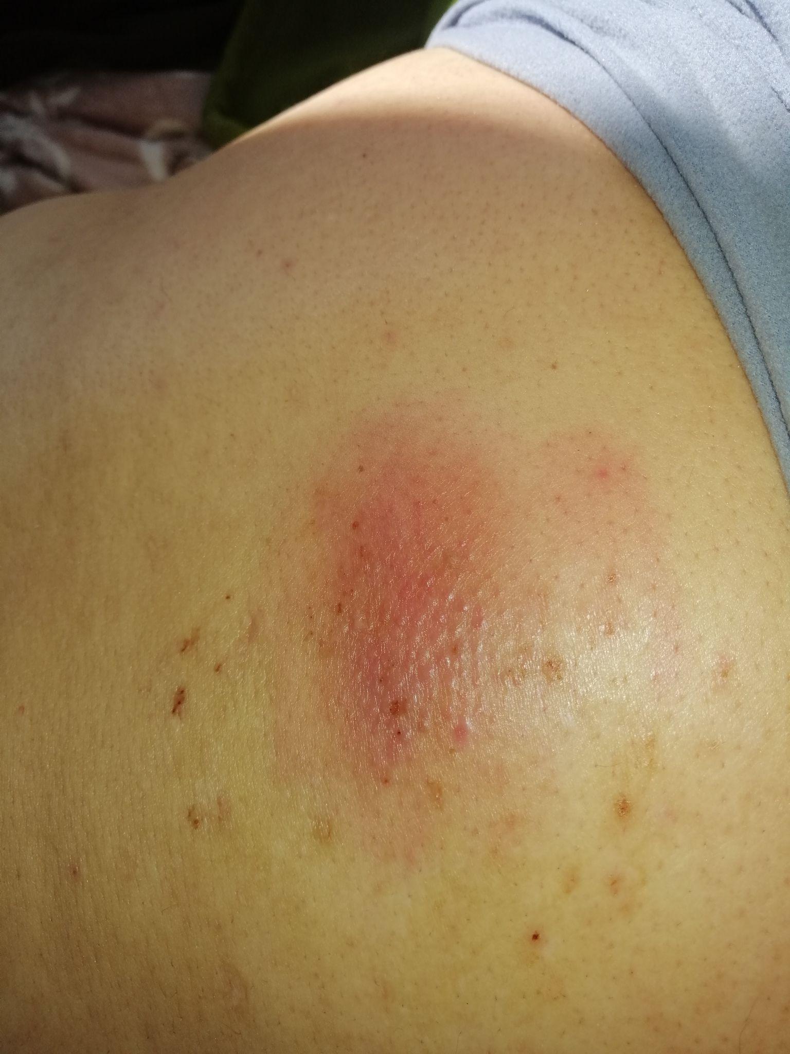 一个火疖子能大到什么地步? - 知乎