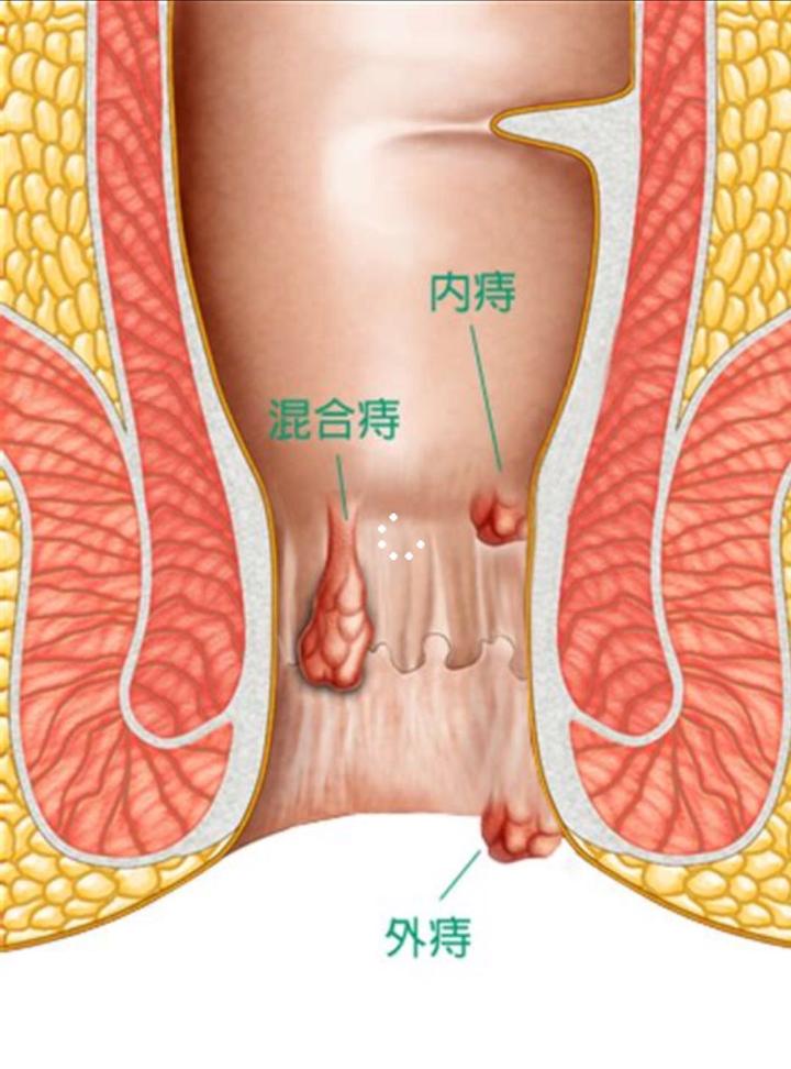 "十人九痔"有道理吗--菊花残系列一