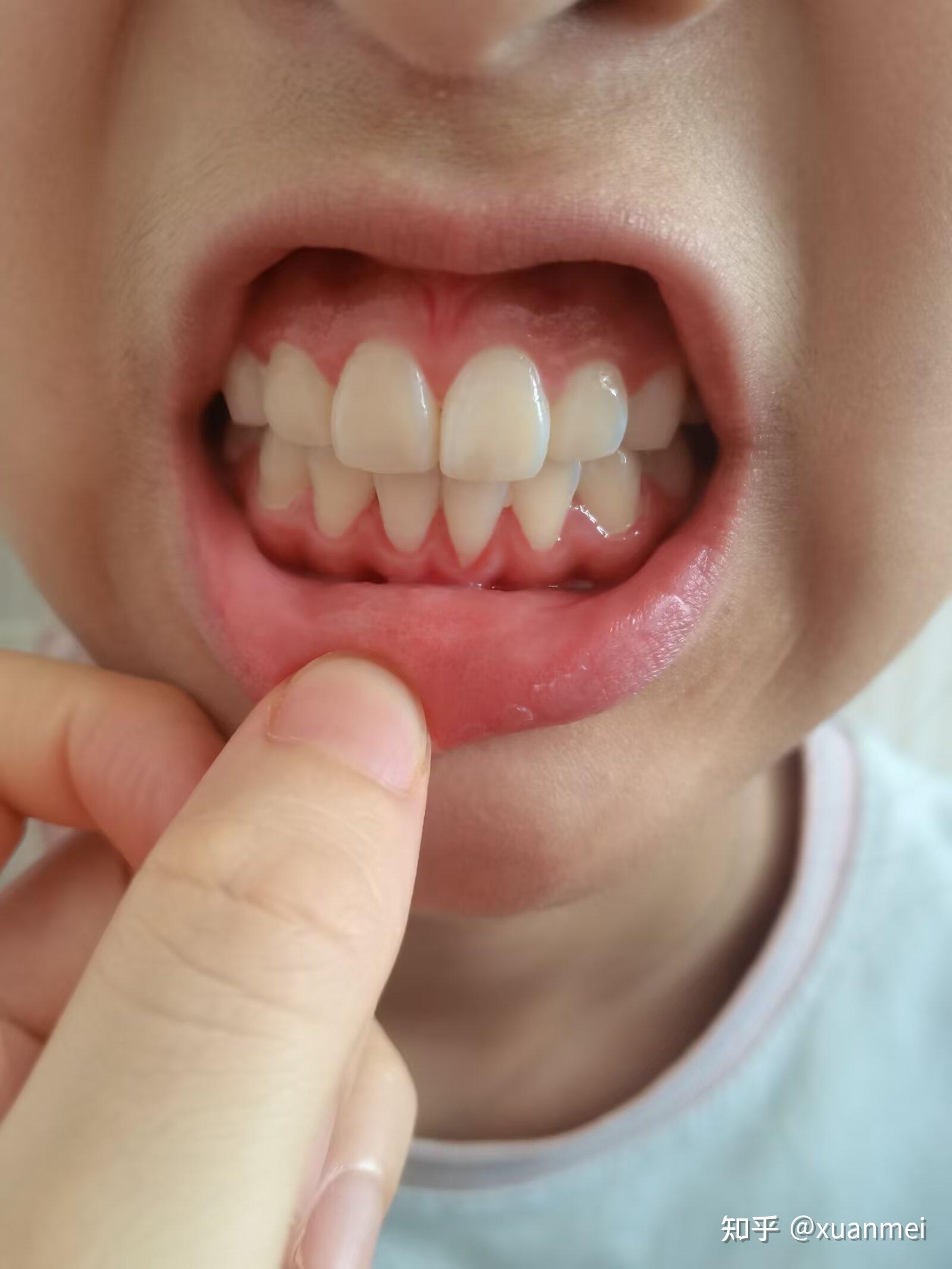 一颗牙齿的牙龈萎缩