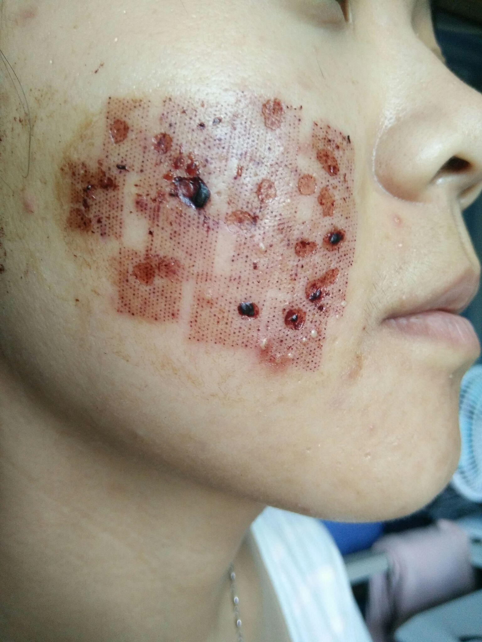 点阵激光去痘坑的效果如何